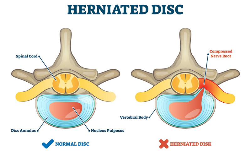 علائم دیسک کمر چیست؟ 🩺 درمان بدون جراحی